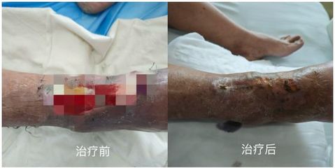 邵阳市第二人民医院:“组合拳”助糖尿病足患者幸免一“截”